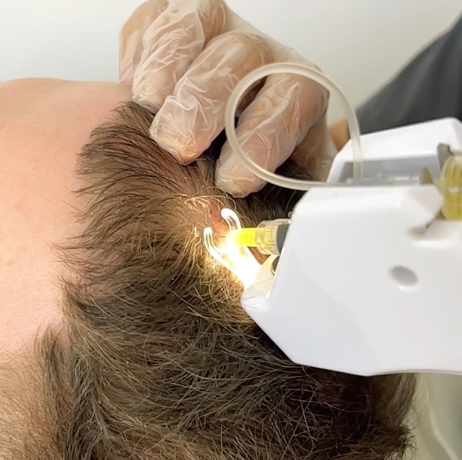 Mesotherapy Hair UK