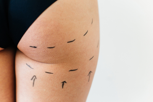 What makes FUE Hair Transplant Procedure the most Successful Technique?