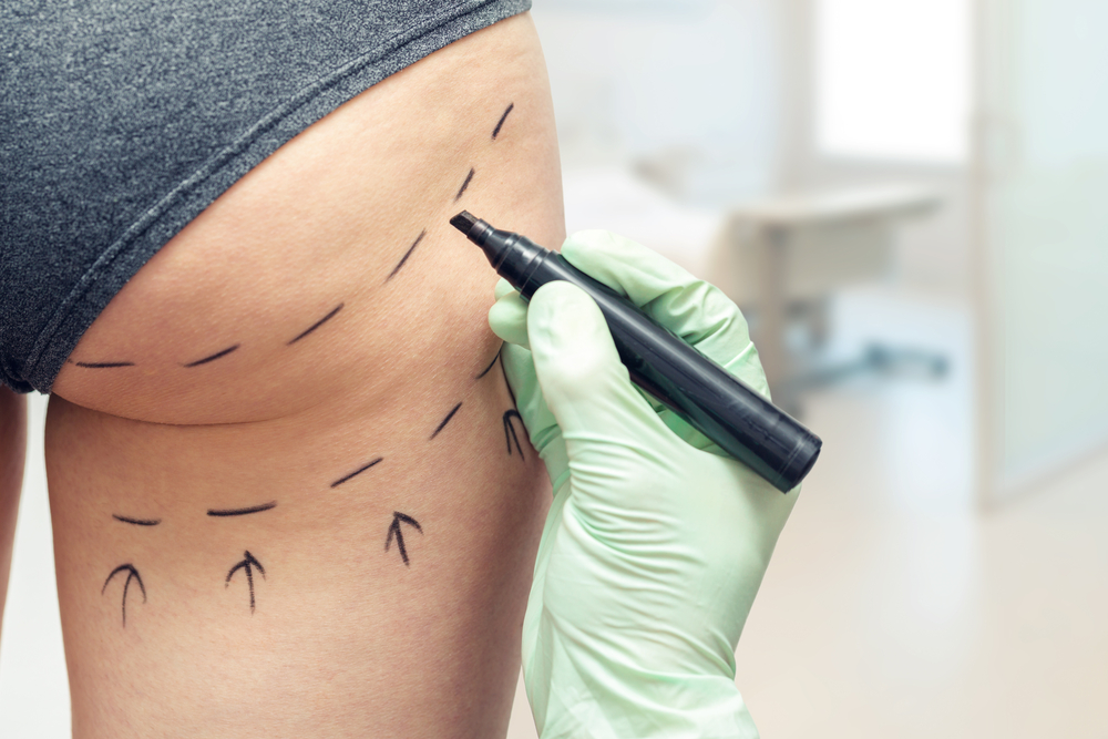 What makes FUE Hair Transplant Procedure the most Successful Technique?
