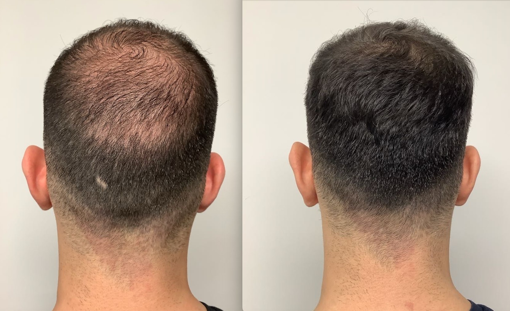 Before and After PRP Hair Loss Treatment at Este