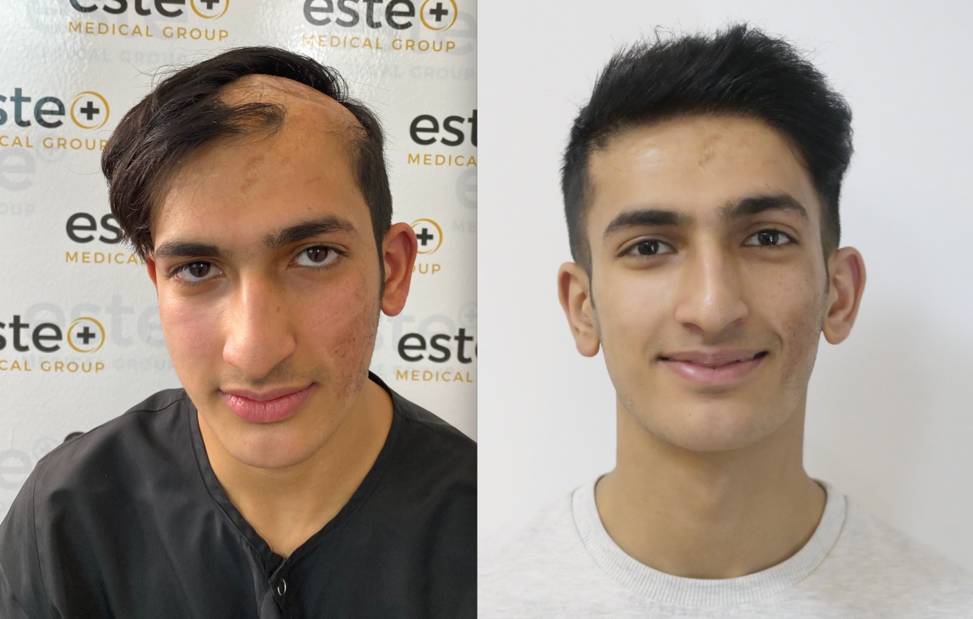 Murat Before and After FUE hair transplant results