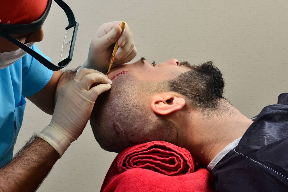 Success Rate of Hair Transplants