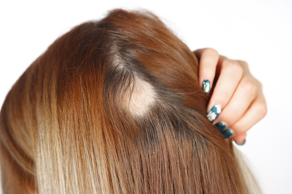 Alopecia: Symptoms, Causes & Treatments