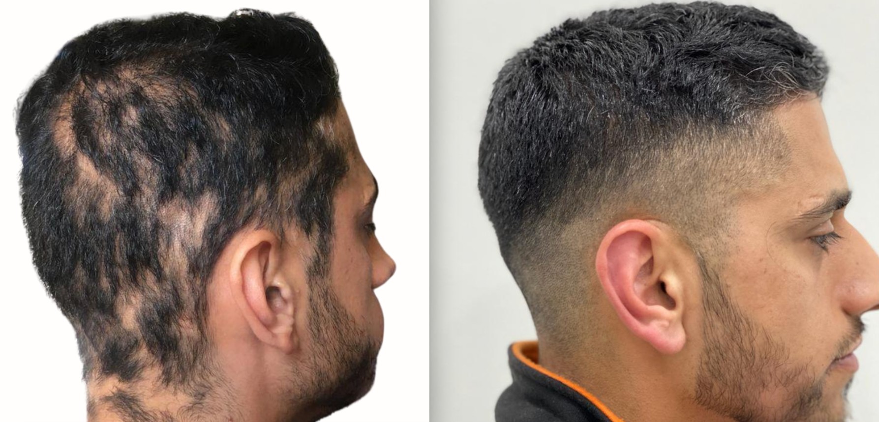 Alopecia before and after result