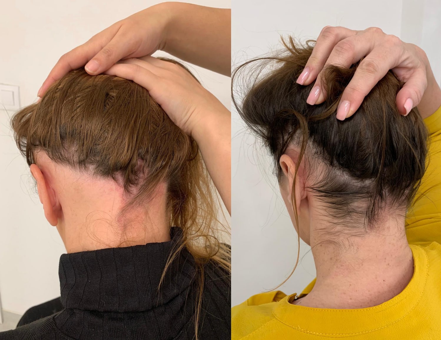 Laser Hair Growth before and after