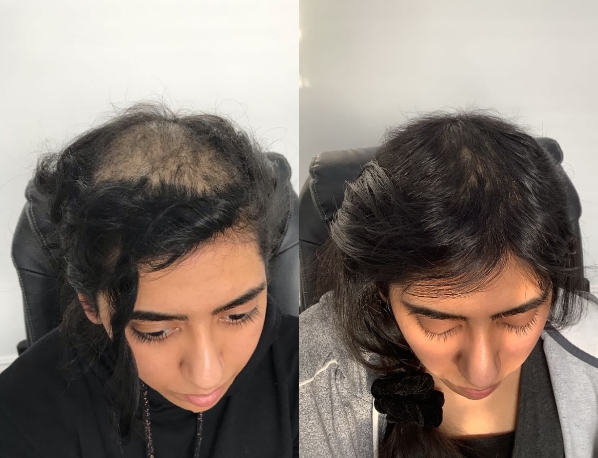 Laser Hair Growth treatment result