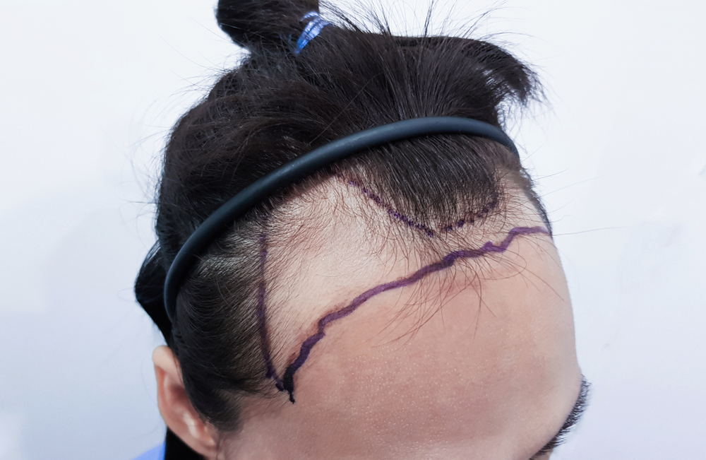 Unshaven Hair Transplant