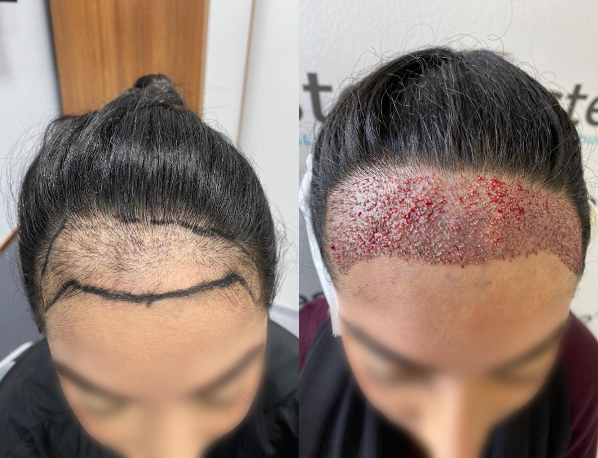 Female Unshaven Hair Transplant Before and After