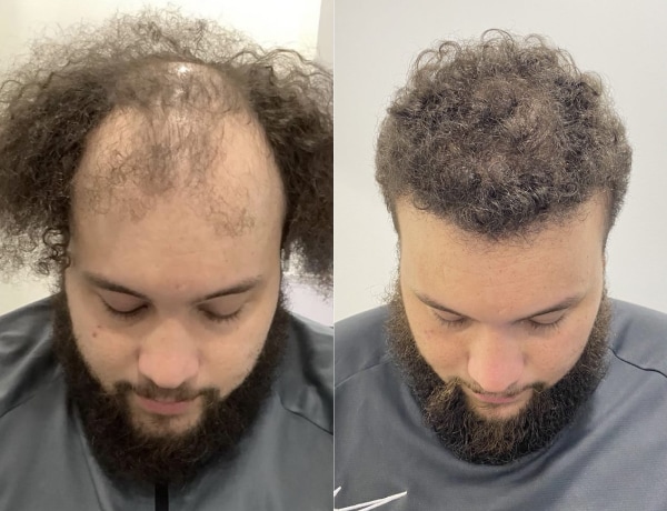 before and after result