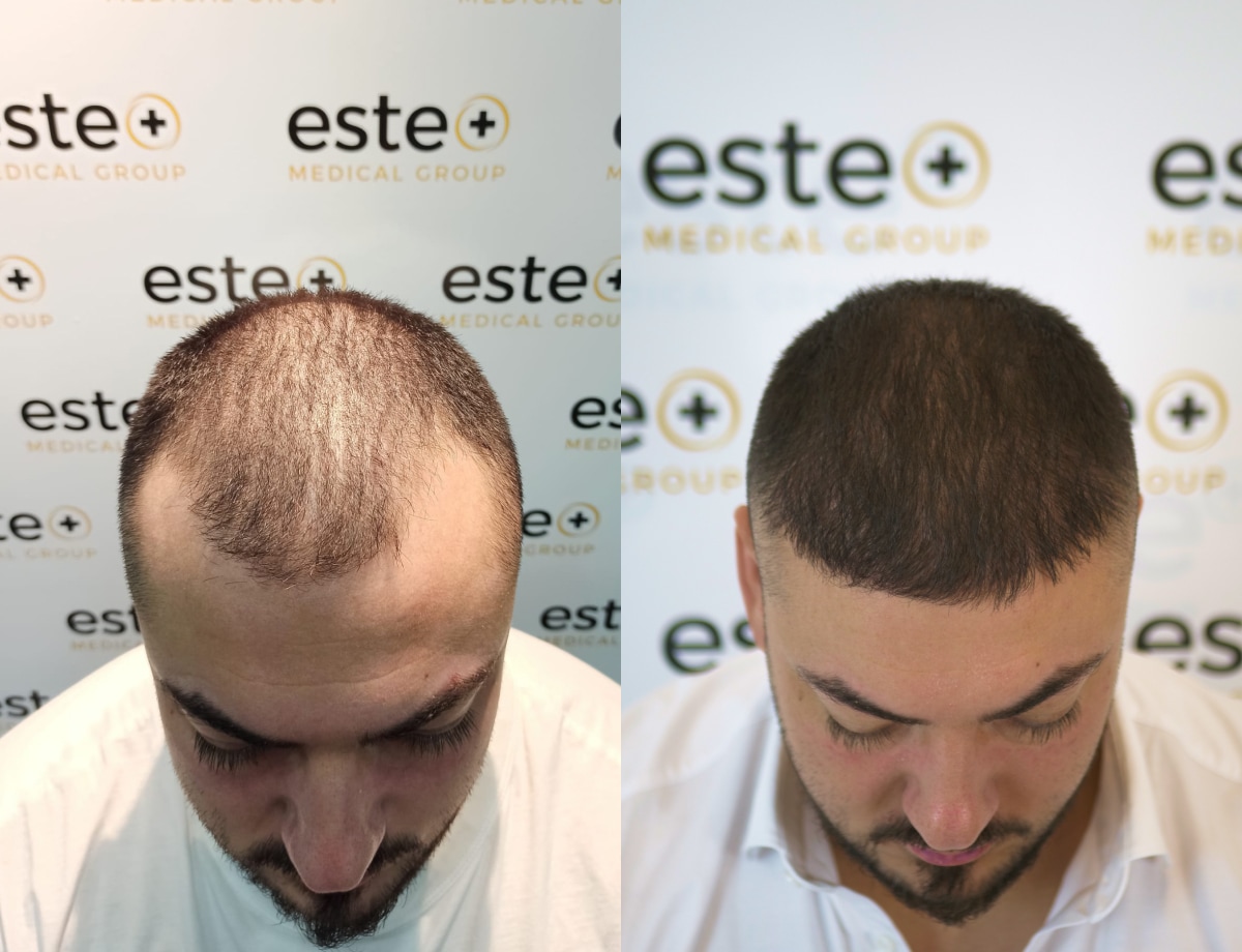 Hair Transplant treatment result