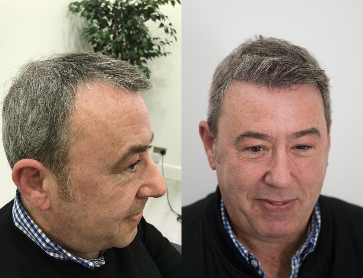Before and after result of hair transplant