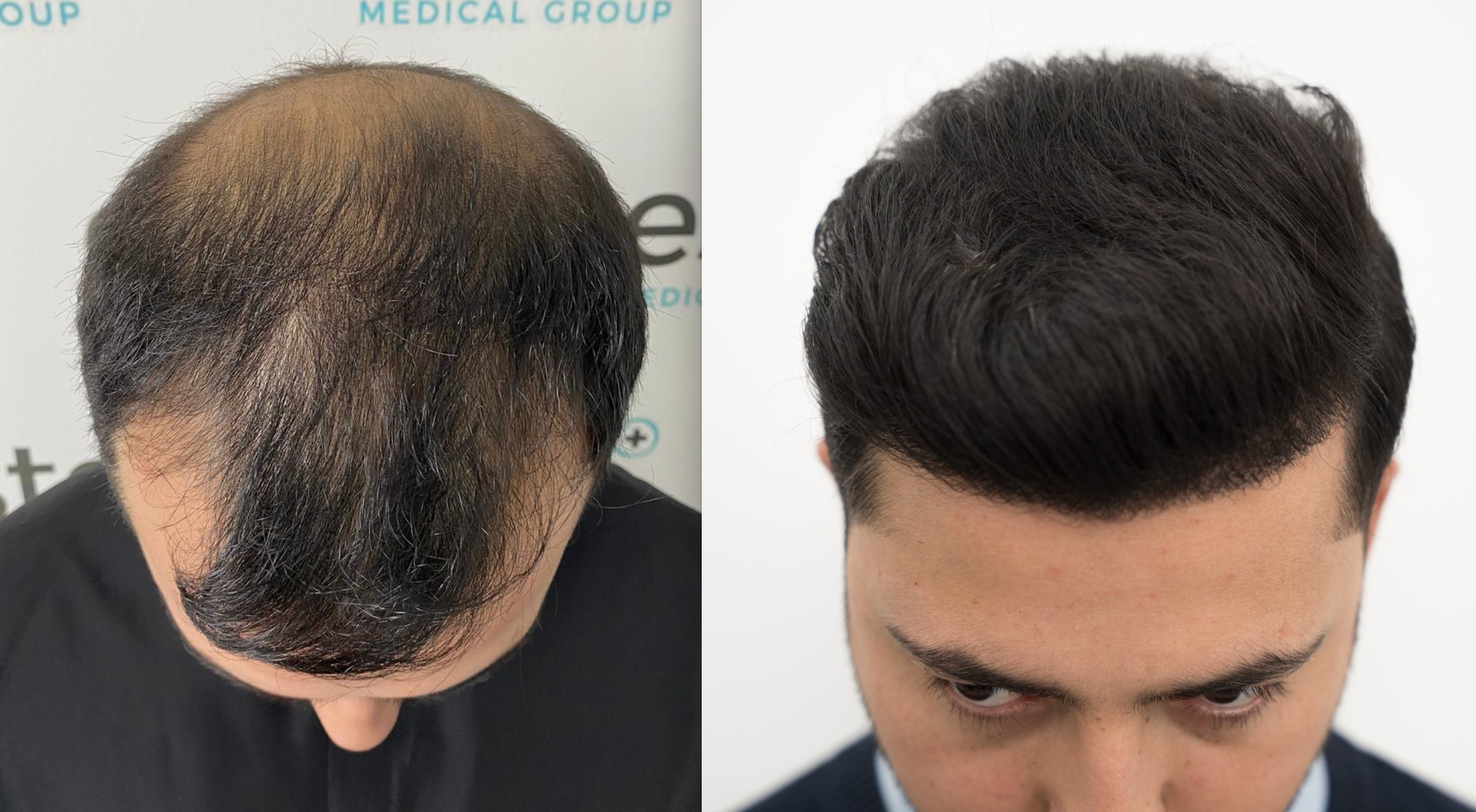 Hair Transplant before and after results
