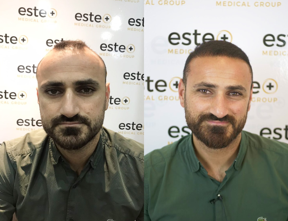 Before and after results