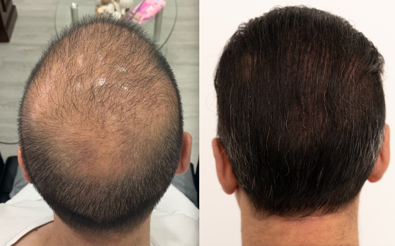 Hair Transplant results