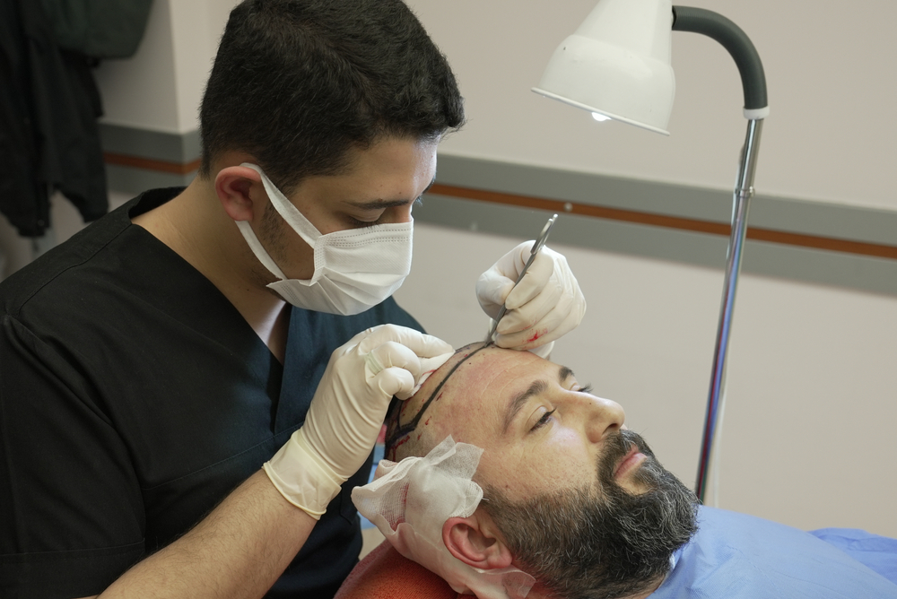 How to Choose a Hair Transplant Clinic in Turkey