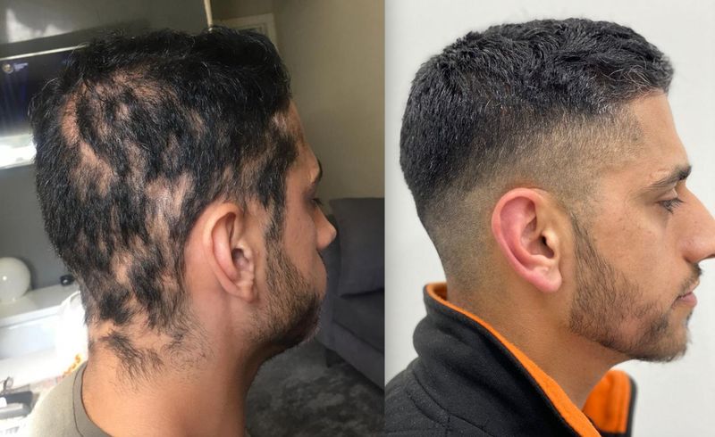 Before & After Jay's Alopecia Hair Loss Treatment