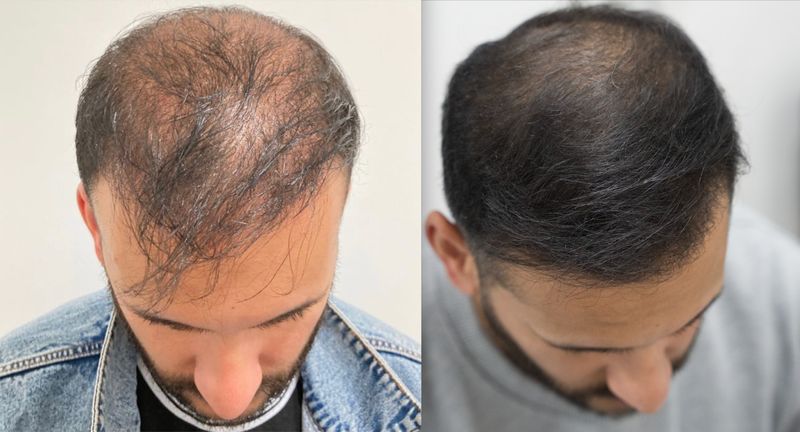 Irfan’s Laser Hair Growth Treatment Before-And-After Photos