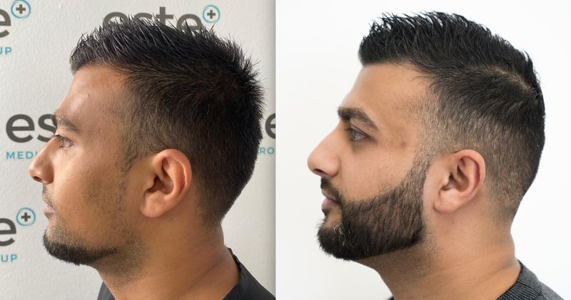 No Beard To Full Beard: Leeds Man Has Successful Beard Transplant