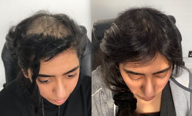 PRP Hair Loss Treatment