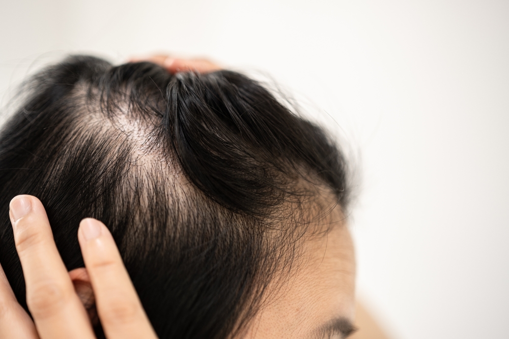 How to Regrow Hair On Bald Spot 
