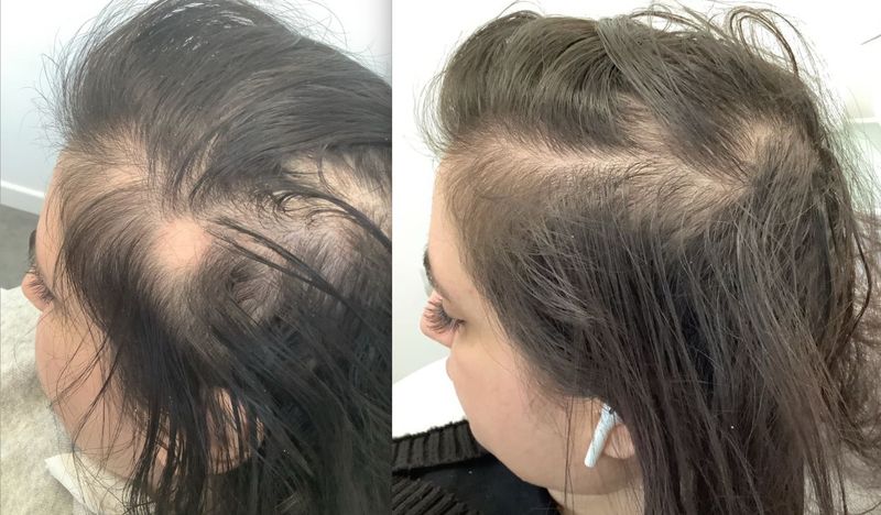 Alopecia before and after PRP & Exciplex Treatment