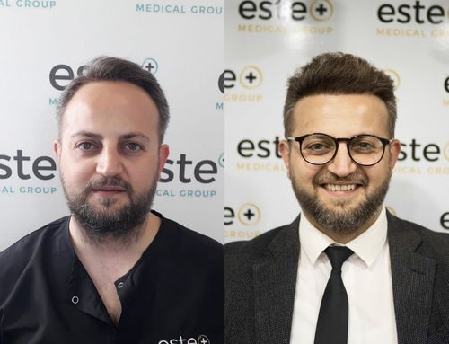 Hair Transplant Aftercare results