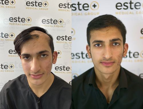 Hair Transplant before and after results