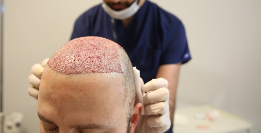 Hair Transplant Aftercare