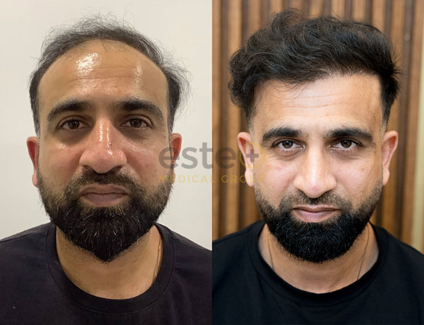 Hair transplant before and after Leeds