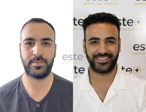 Hair transplant before and after Leeds
