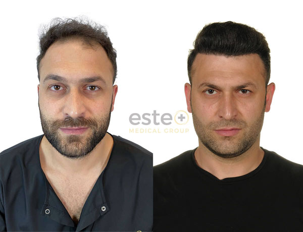 Hair transplant before and after Leeds