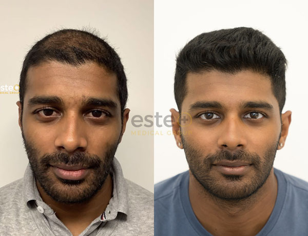 Hair transplant before and after Leeds