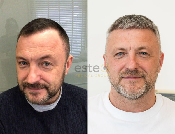 Hair transplant before and after Leeds