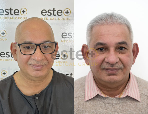 FUE Hair Transplant Results