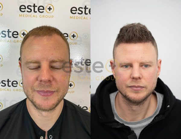 FUE Hair Transplant Results