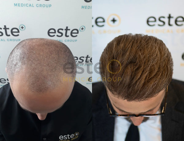 Hair transplant before and after Leeds