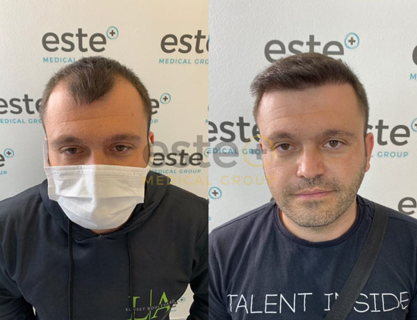 Hair transplant before and after Leeds