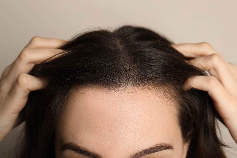 Hair Transplants for Women