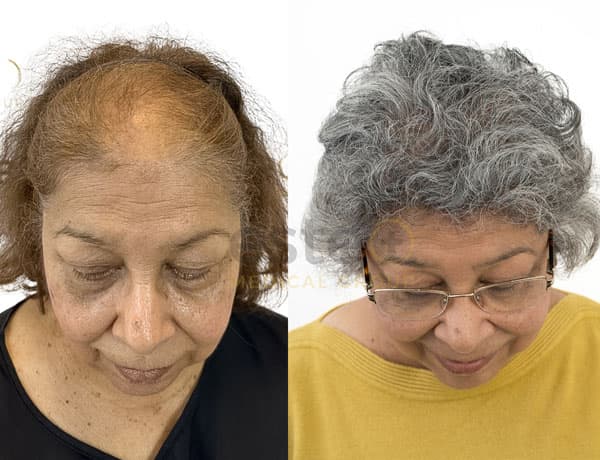 Halima's Hair transplant - Este UK