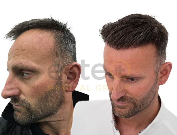 Hairline Lowering before and after results