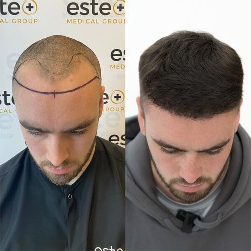 Hairline Lowering results