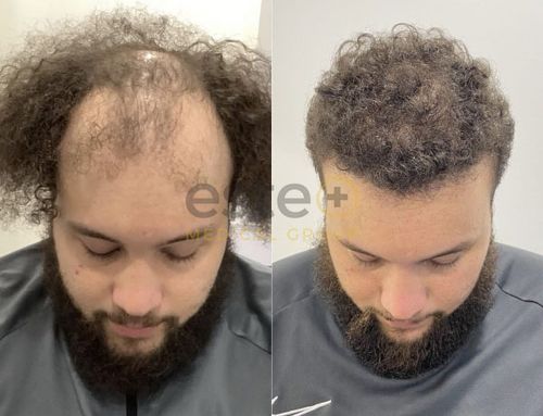 before and after results