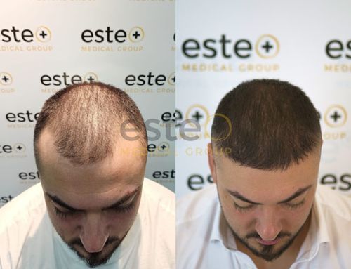 Hair result after treatment