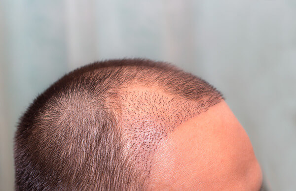 Duckling Phase Of Hair Transplant Process