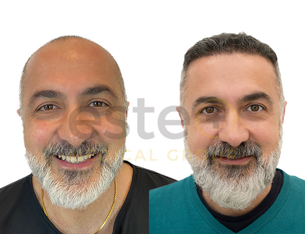Hair transplant before and after Leeds