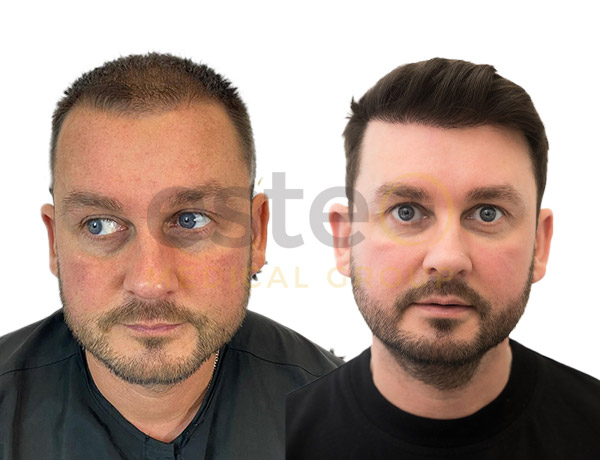 Hair transplant before and after Leeds