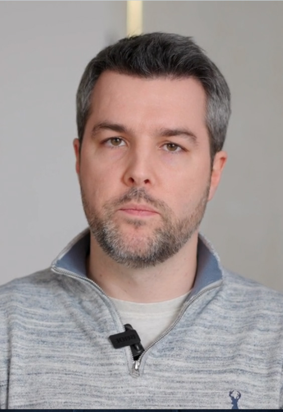 Jason Mitchell hair transplant - Este