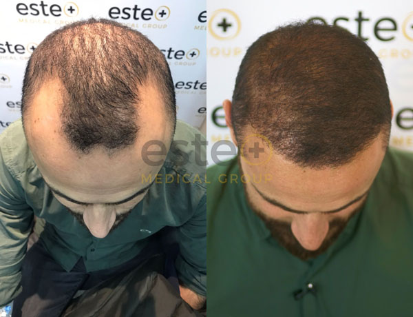 Hair transplant before and after Leeds