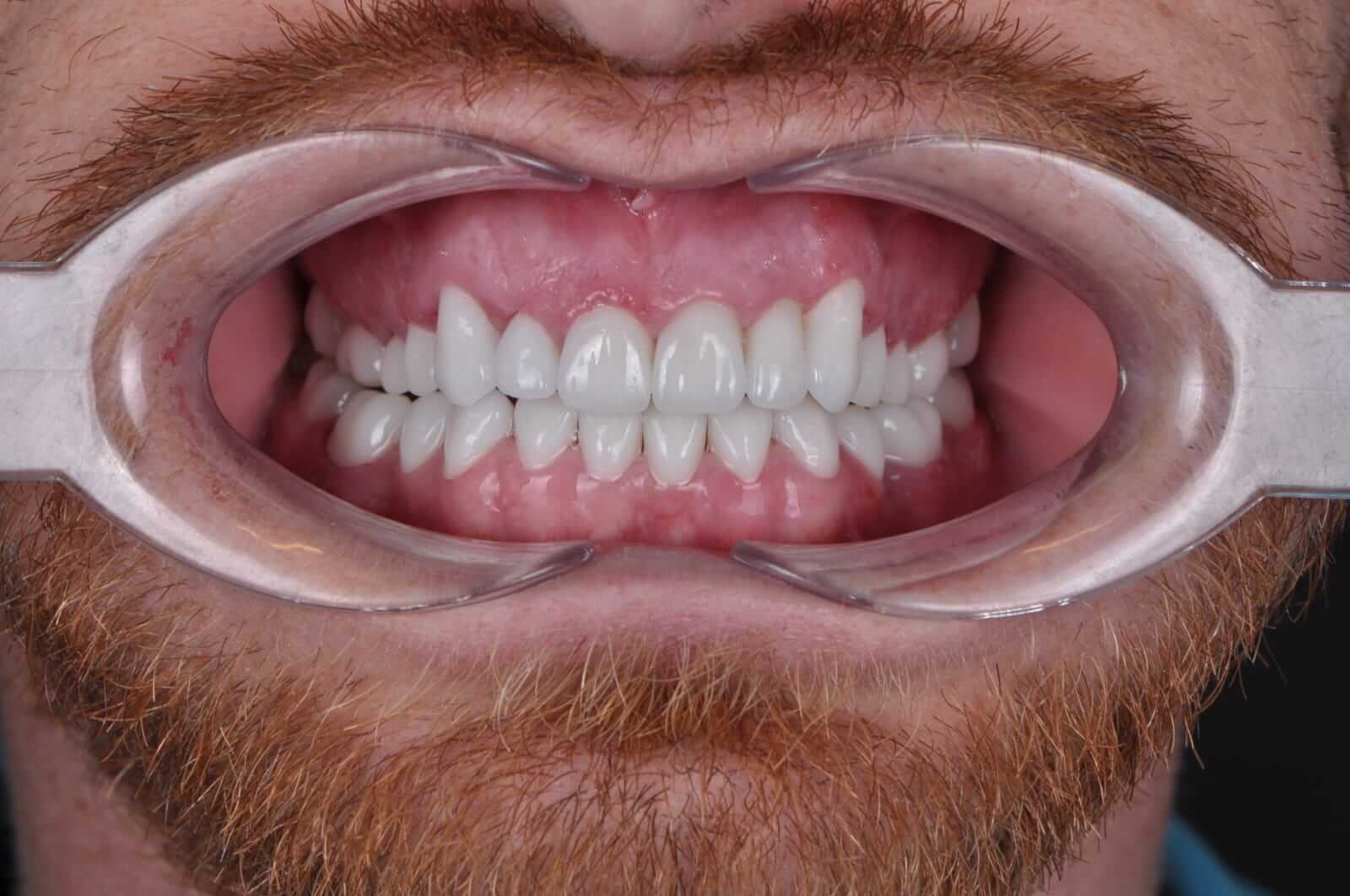 What makes FUE Hair Transplant Procedure the most Successful Technique?