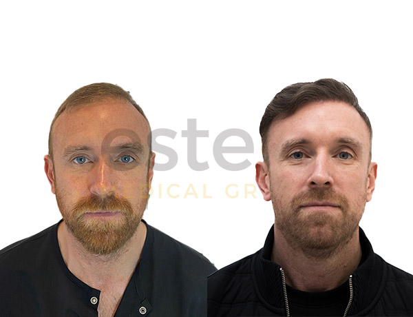 Hair transplant before and after Leeds